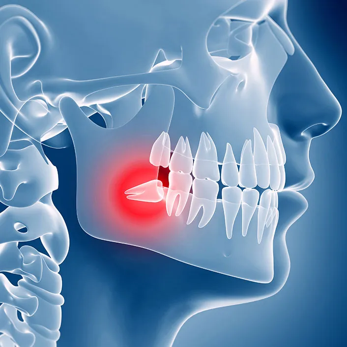 Wisdom Teeth St. Augustine FL | Wisdom Tooth